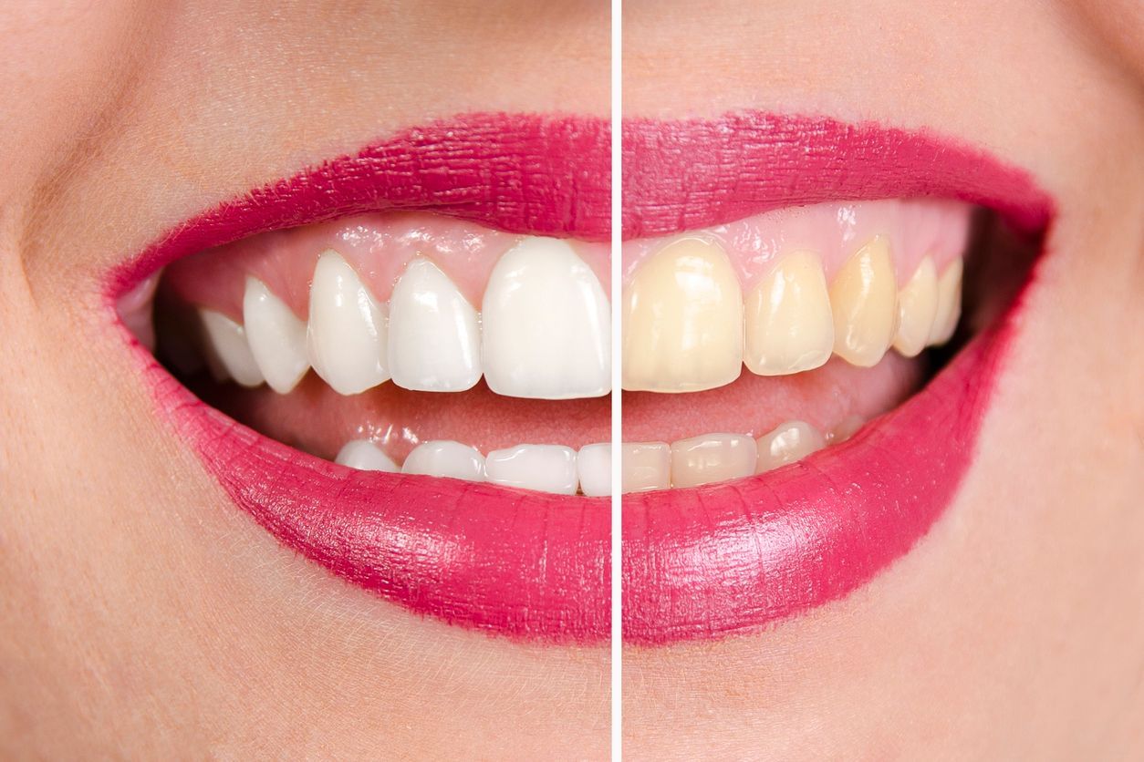 Split image: teeth comparison; left side, white; right side, yellow. Pink lips, close-up.