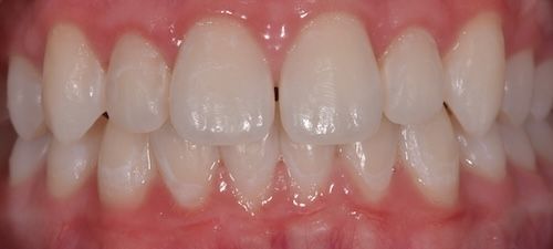Close-up of a person's healthy teeth, showing white enamel, pink gums, and a slight gap between the front teeth.