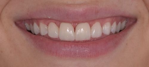 Close-up of a smiling person's teeth; white, well-aligned teeth and pink lips.