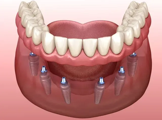 Dental Implants vs. Other Options: Why Stuart, FL Residents Prefer Implants