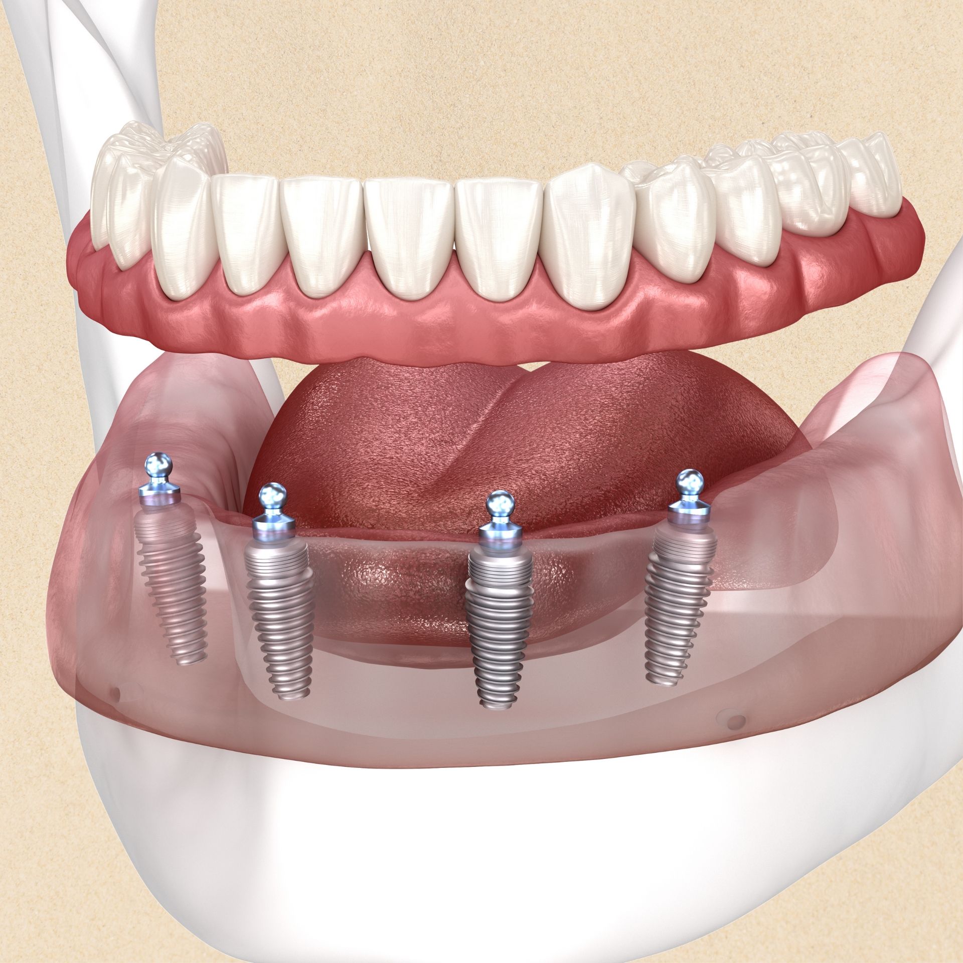 A close up of a person's teeth with clear braces
