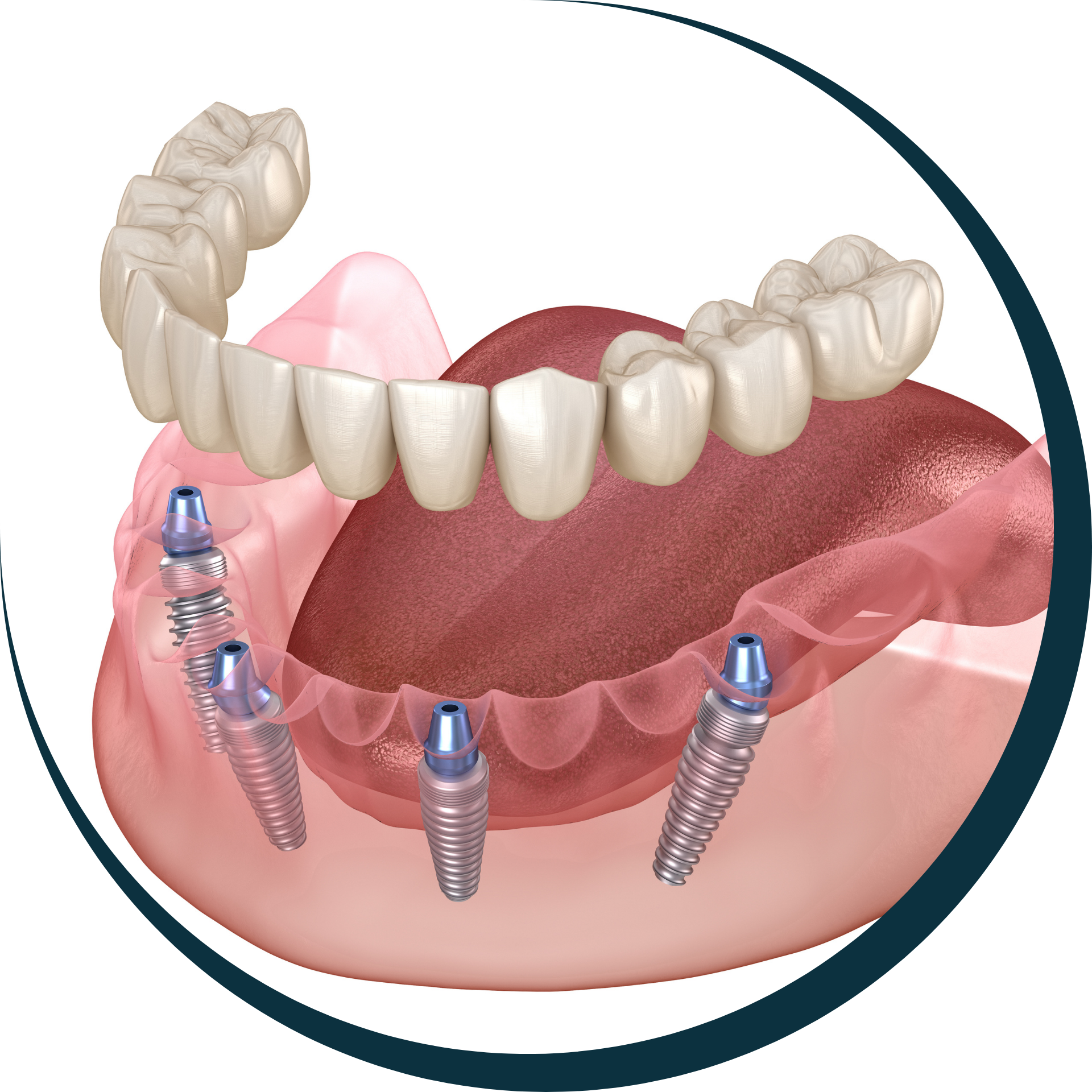 Dental implant supported dentures, showing upper and lower teeth attached to implants in the jaw.