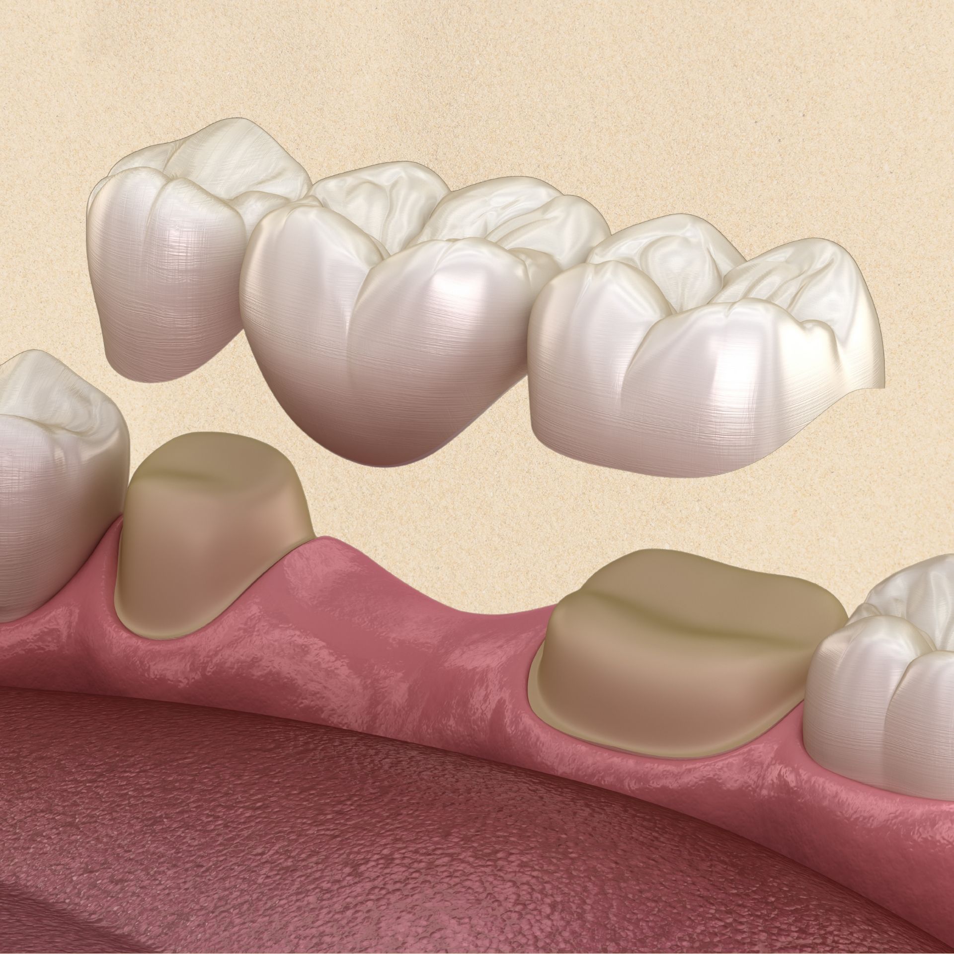 A computer generated image of a dental bridge between two teeth
