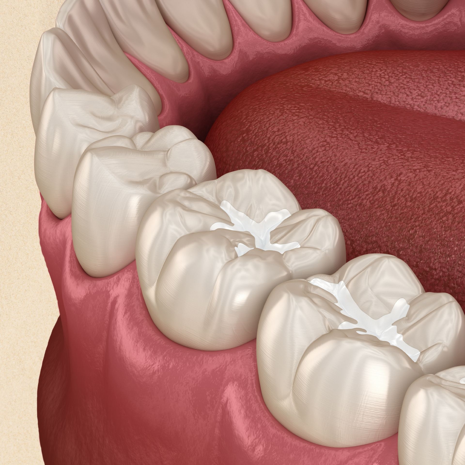 A close up of a tooth with a white filling in it