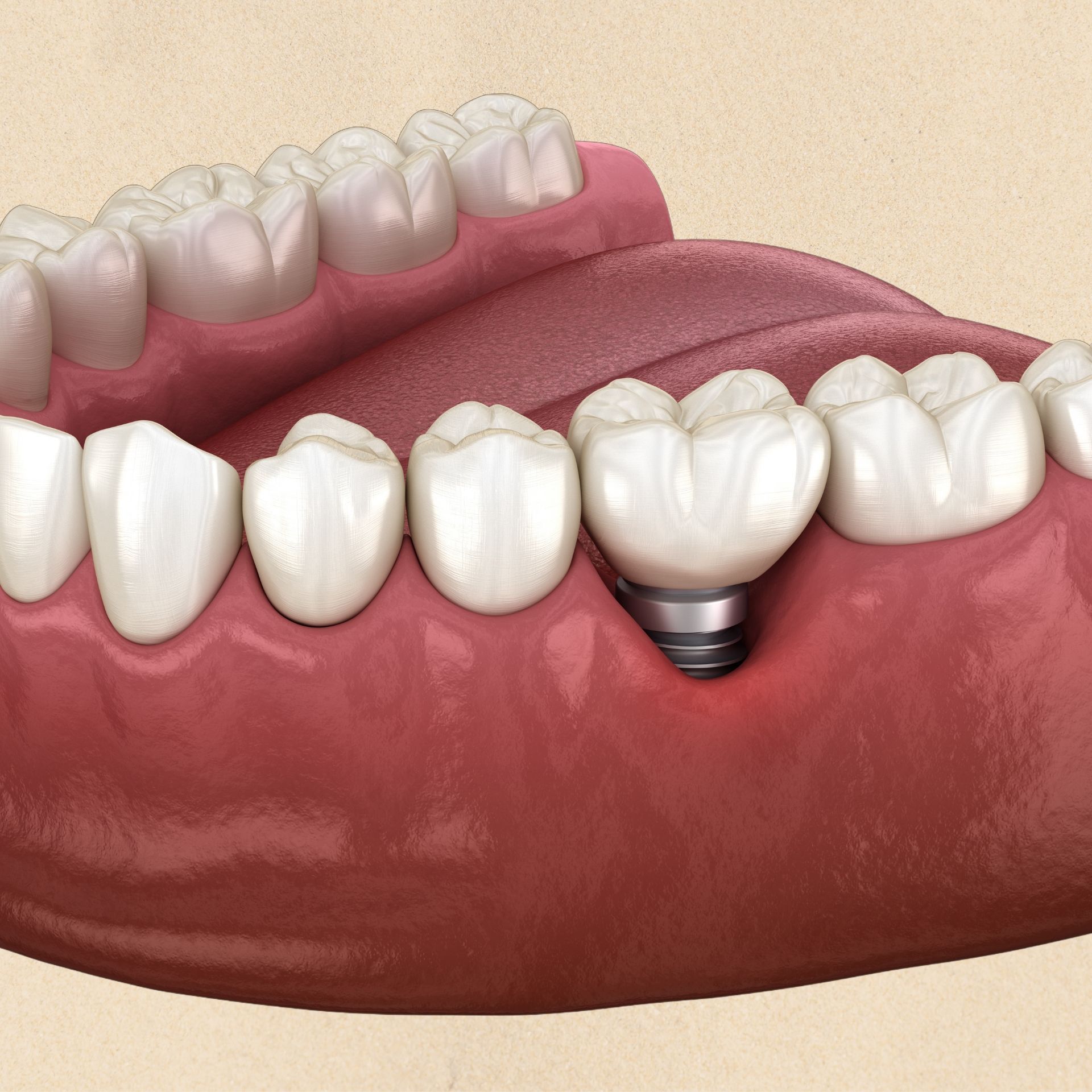 A close up of a person's teeth with clear braces