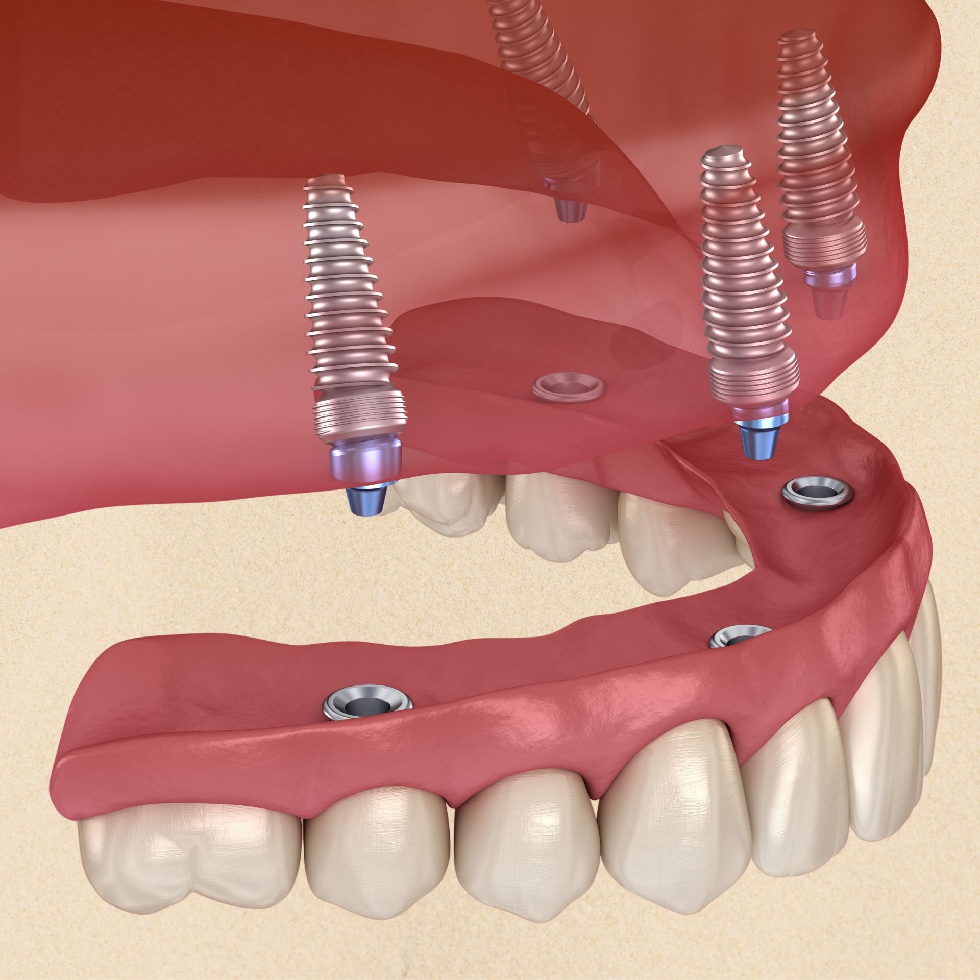 A close up of a person's teeth with clear braces