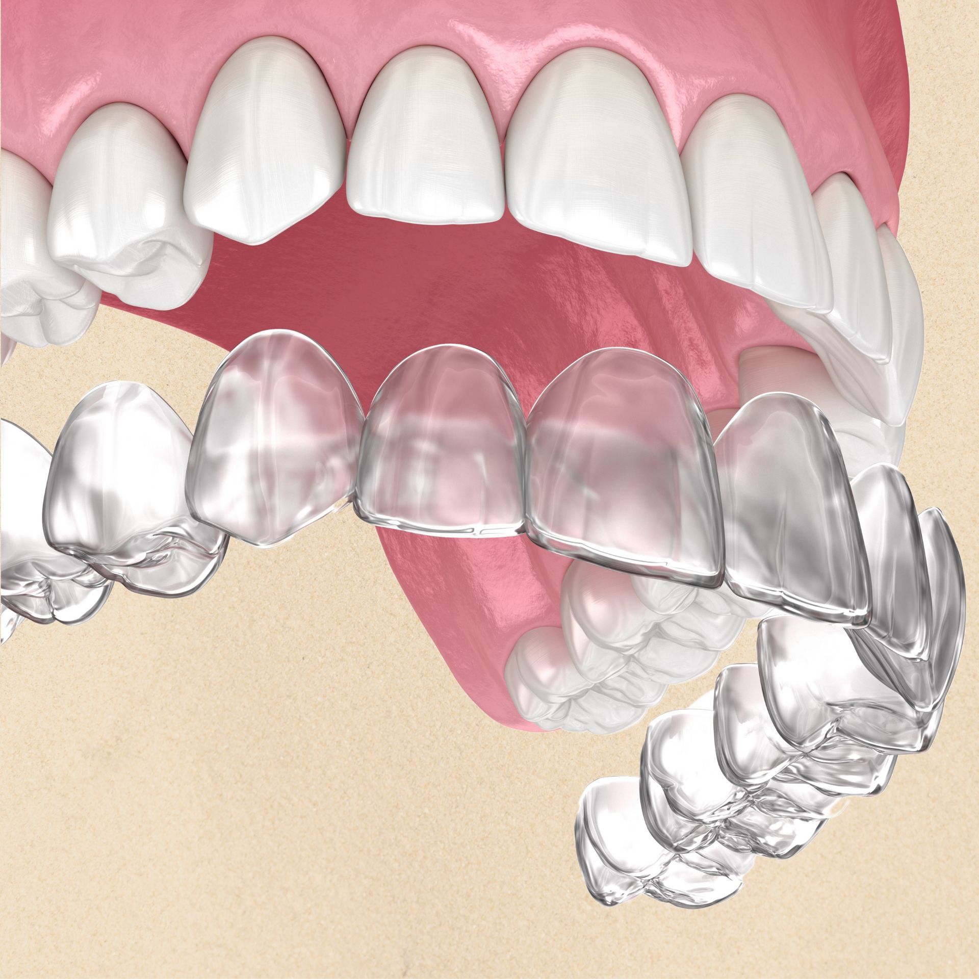 A close up of a person's teeth with clear braces