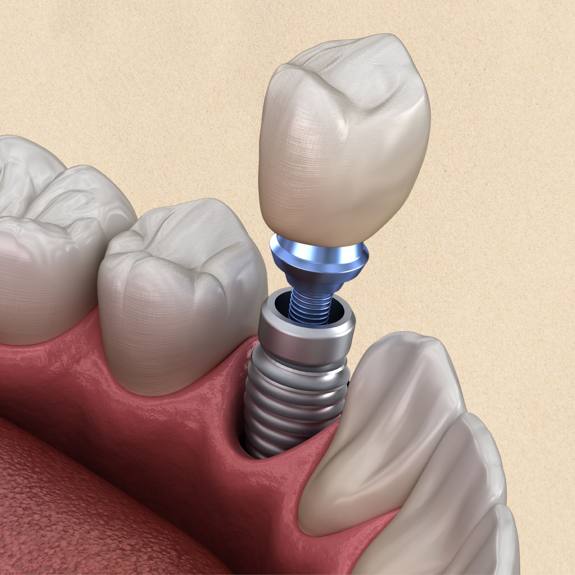 A close up of a person's teeth with clear braces