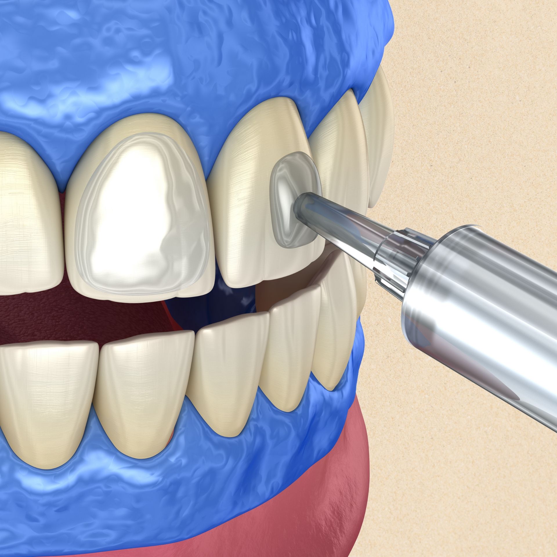 A close up of a person 's teeth with a syringe in it