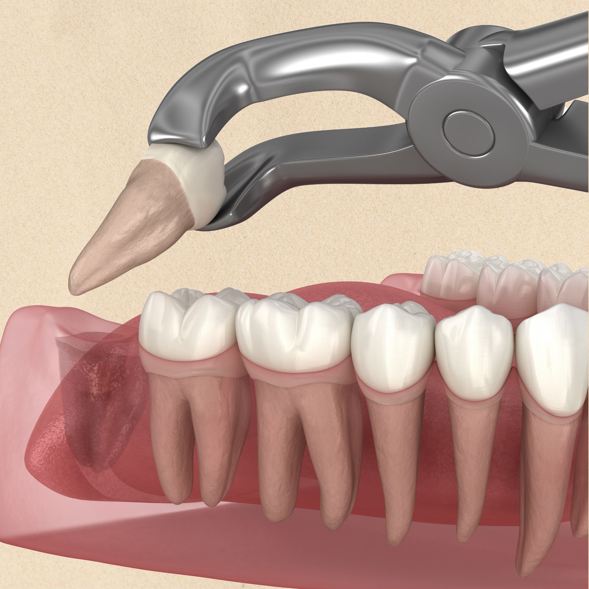 A tooth is being removed by a pair of dental pliers
