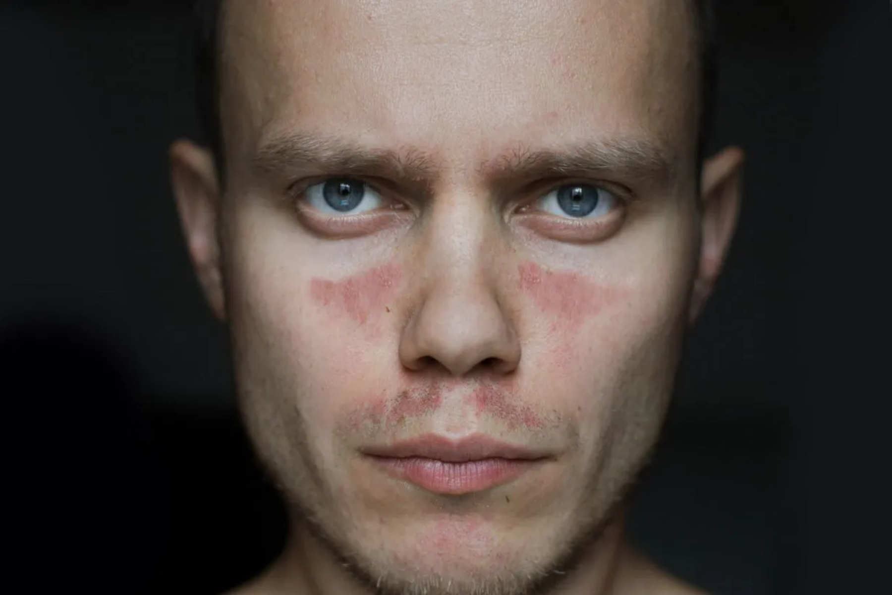 Close-up portrait showing characteristic lupus butterfly rash across nose and cheeks, with bright blue eyes against dark background, illustrating common systemic lupus erythematosus symptoms