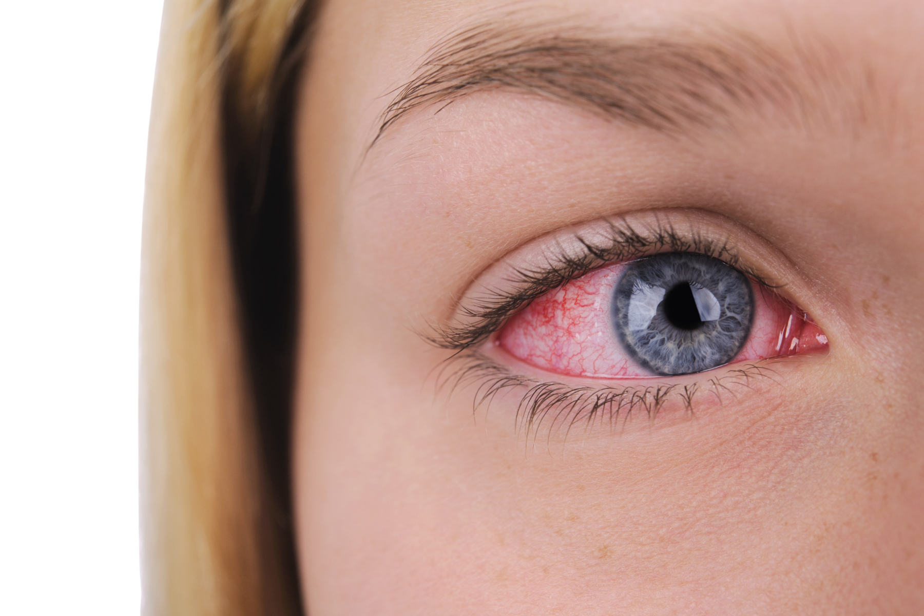 Close-up of bloodshot eye showing scleritis, a common eye inflammation associated with relapsing polychondritis