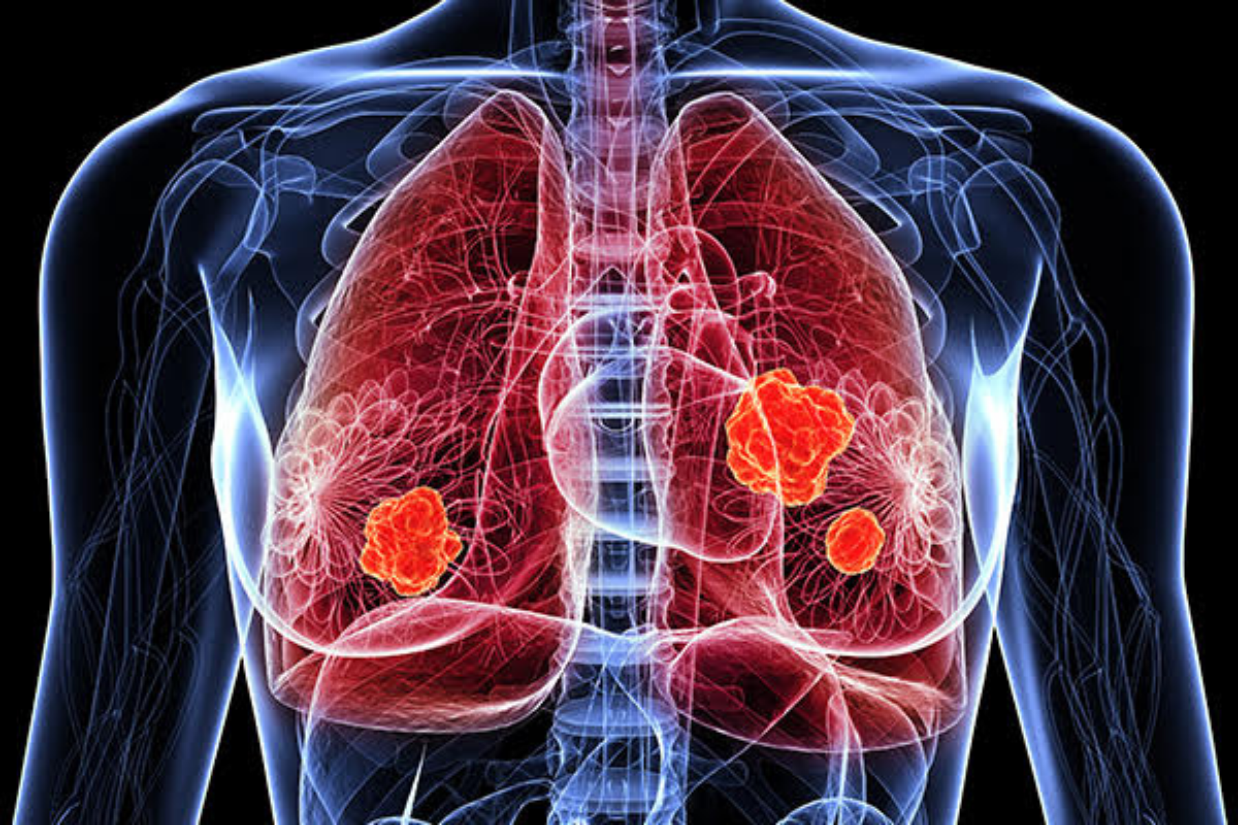 3D medical scan showing detailed view of lungs with visible tumors highlighted in bright orange against red lung tissue and blue skeletal outline