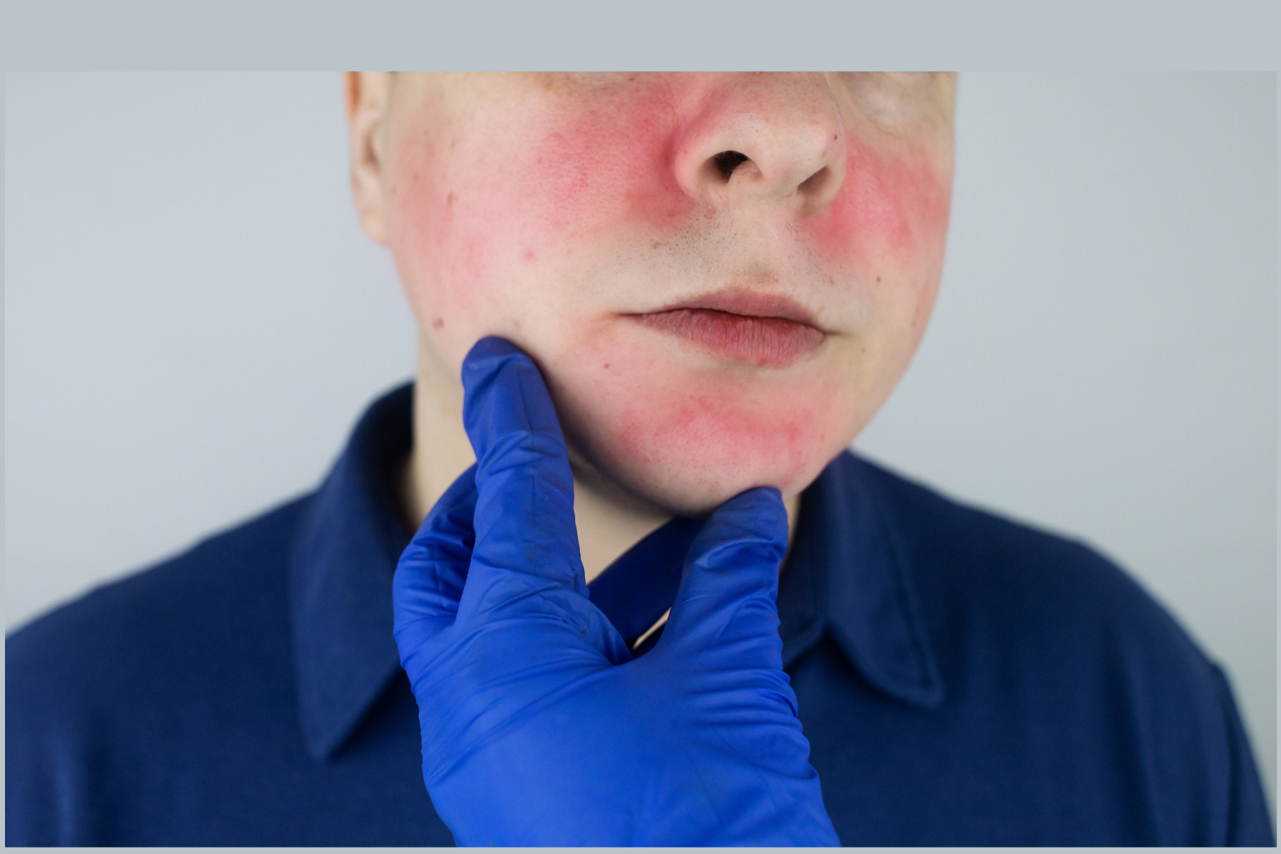 Facial redness and skin tightening of a male patient being examined with blue gloved hand, showing characteristic skin changes of scleroderma