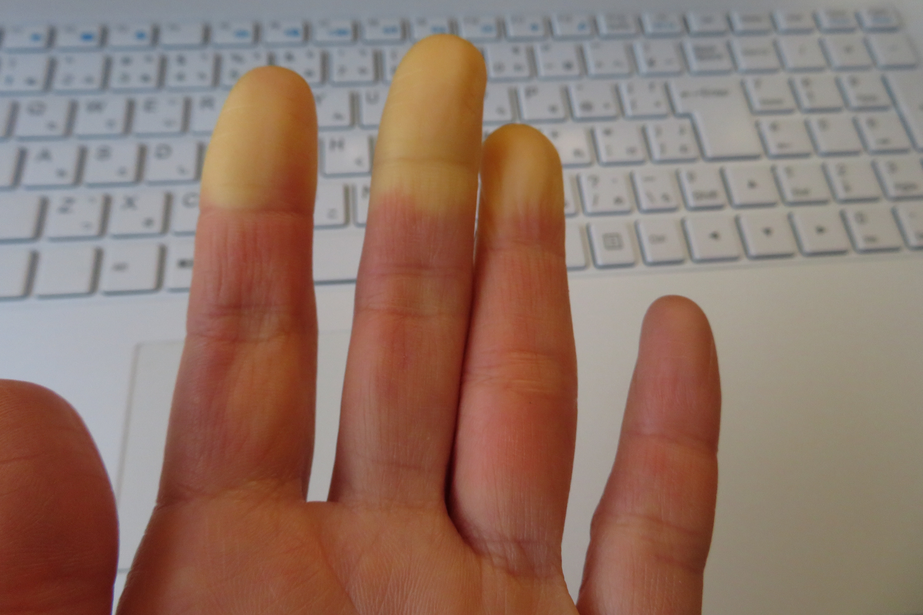 Hand showing Raynaud's phenomenon (very common with scleroderma) with distinct color changes in fingers, displaying characteristic white/pale yellow tips against normal skin tone, photographed in front of white keyboard