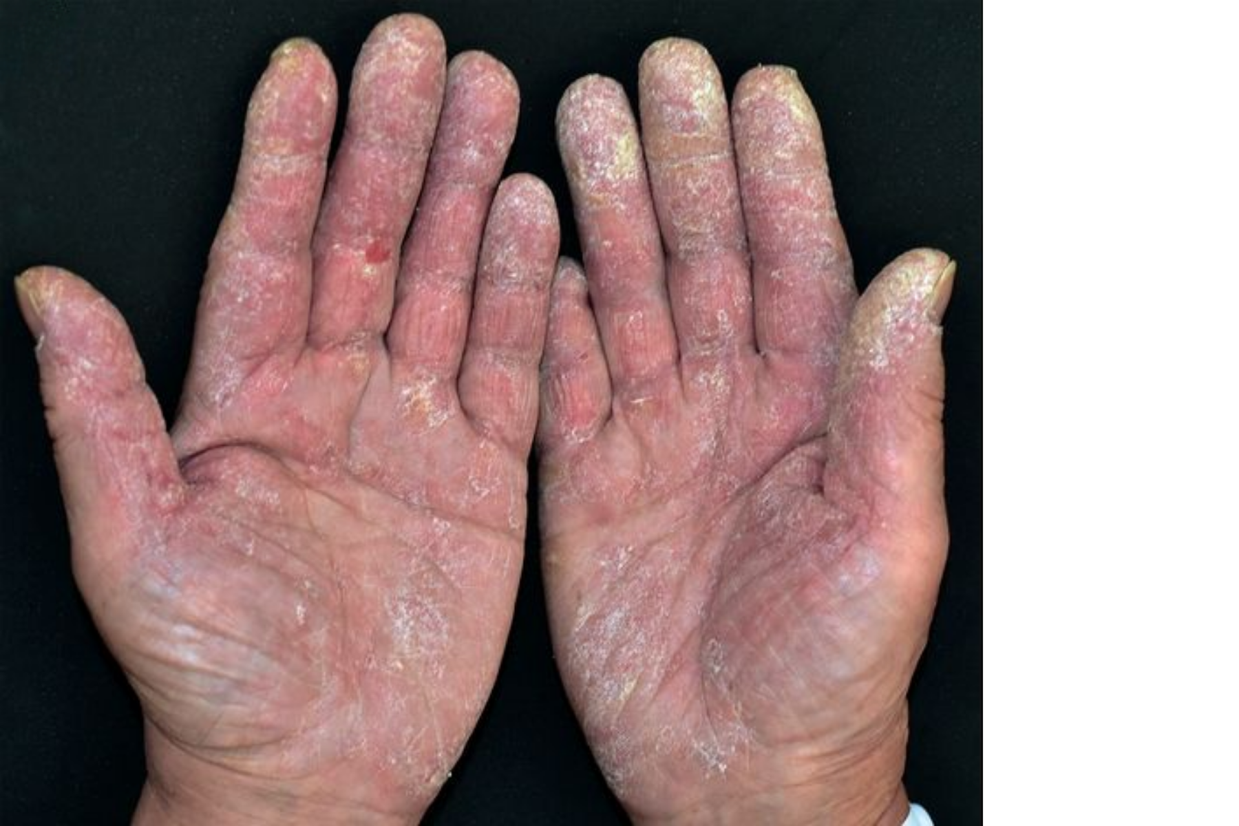 Severe mechanic's hands - rough, cracked, and scaling palms that are a classic sign of Antisynthetase Syndrome