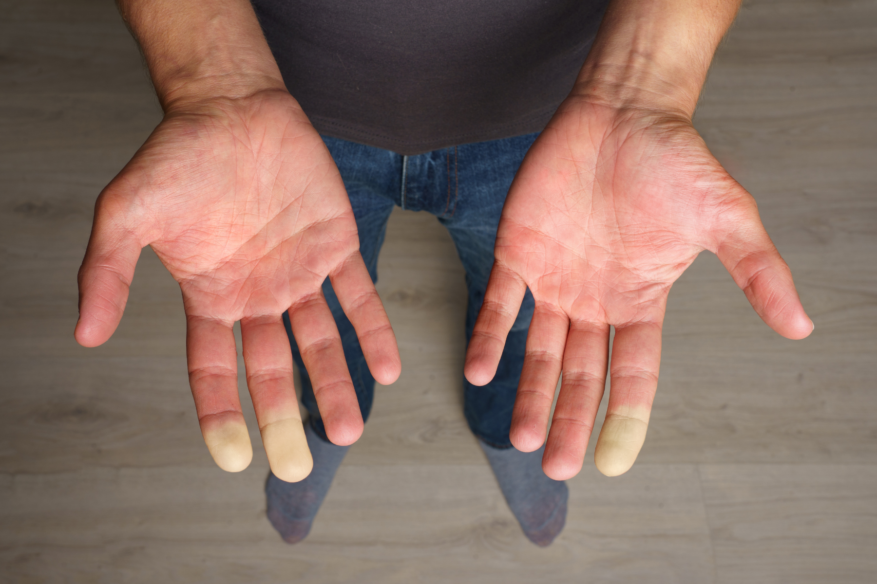 Hands showing Raynaud's phenomenon common in MCTD, with distinct color changes in fingertips from poor circulation