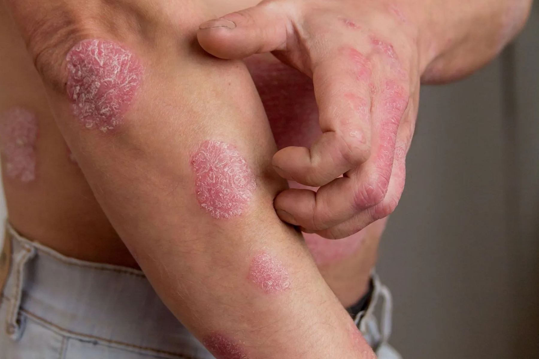 Close-up of psoriasis skin lesions showing characteristic round, pink, scaly patches on a person's arm and hand