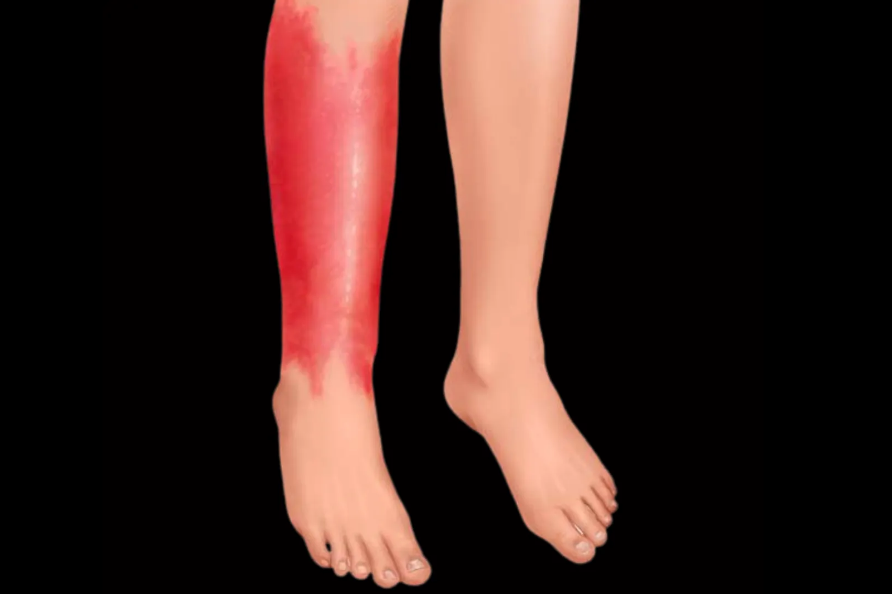 Illustration comparing a normal leg to one with redness and inflammation, showing the skin inflammation that can occur during FMF attacks