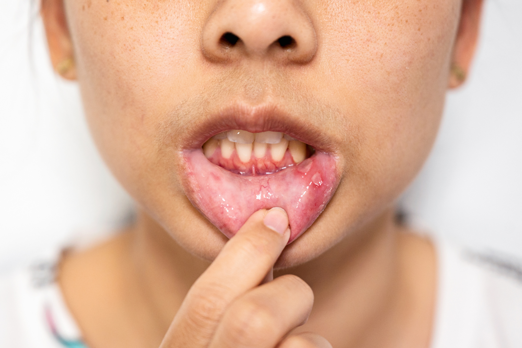 Close-up of mouth ulcers and inflammation, which commonly occur during HIDS flare-ups