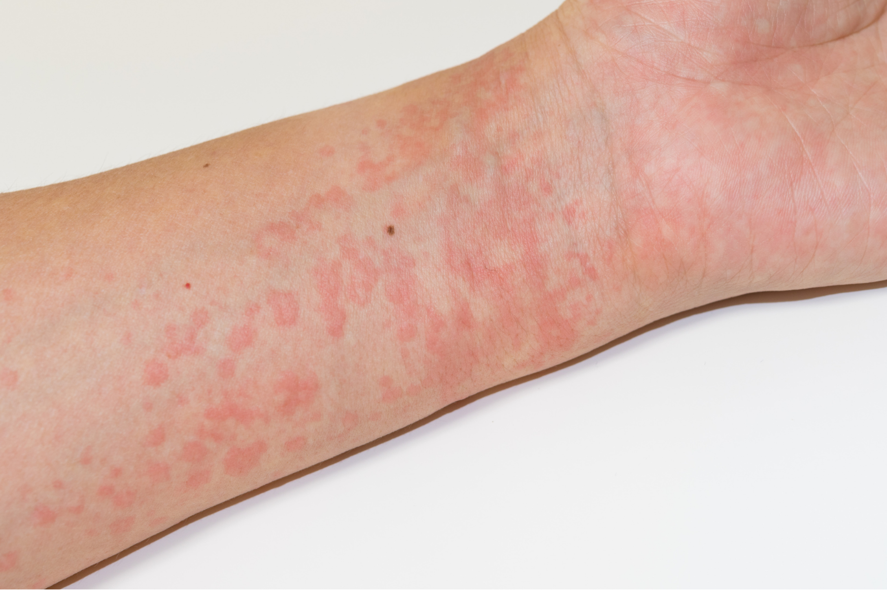 Characteristic red, hive-like rash on forearm typical of Schnitzler Syndrome's chronic urticaria