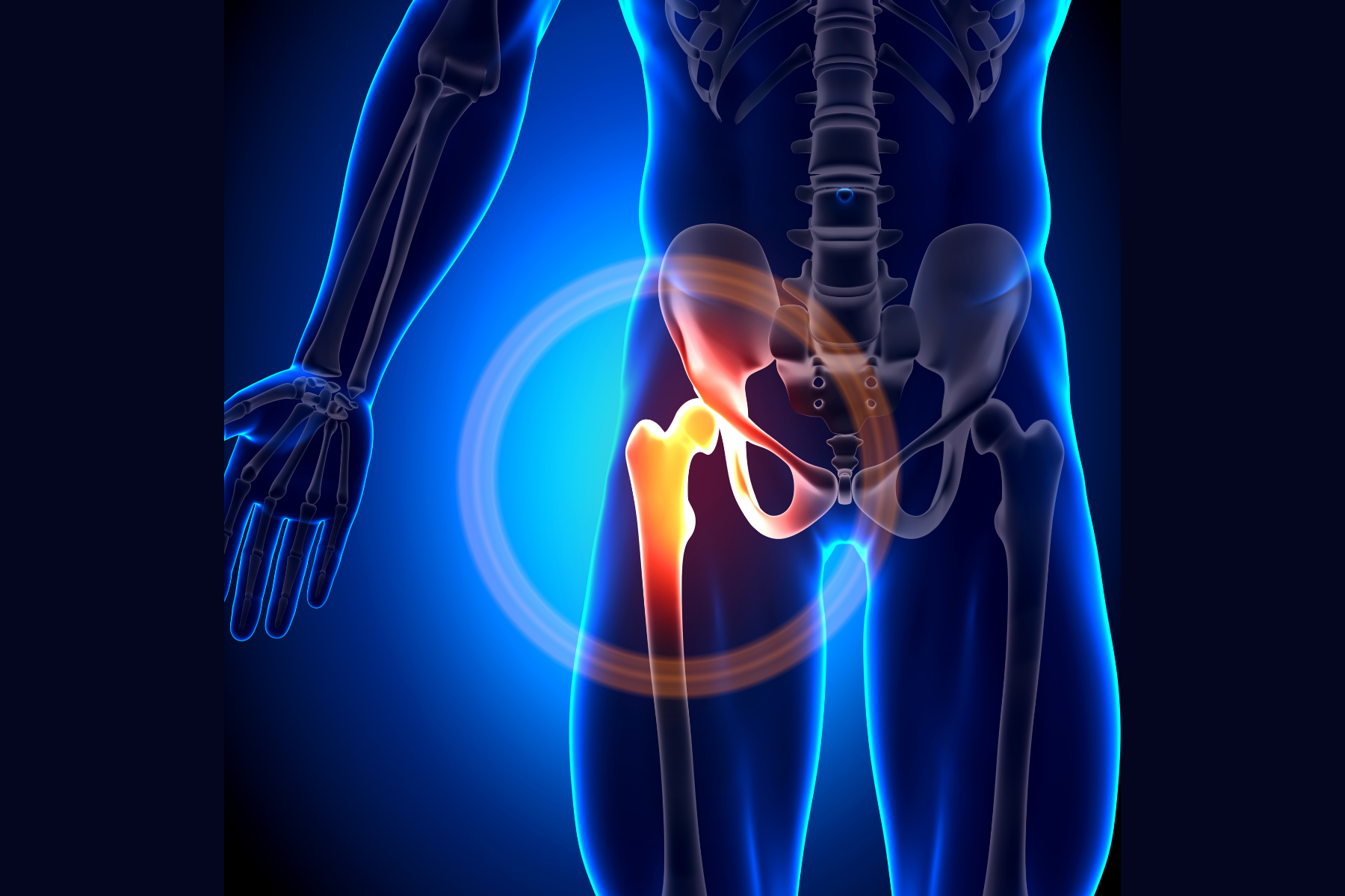 Medical illustration showing hip bone inflammation highlighted in red and yellow, demonstrating how CNO/CRMO affects bones