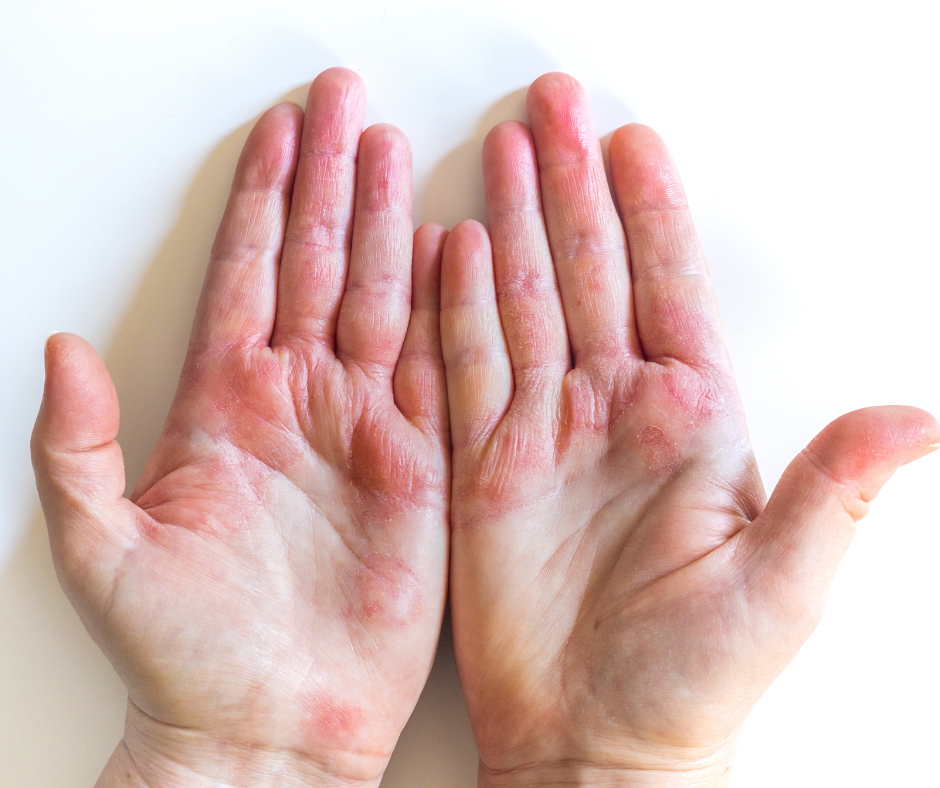 A pair of palms showing a skin rash with reddish patches characteristic of antisynthetase syndrome