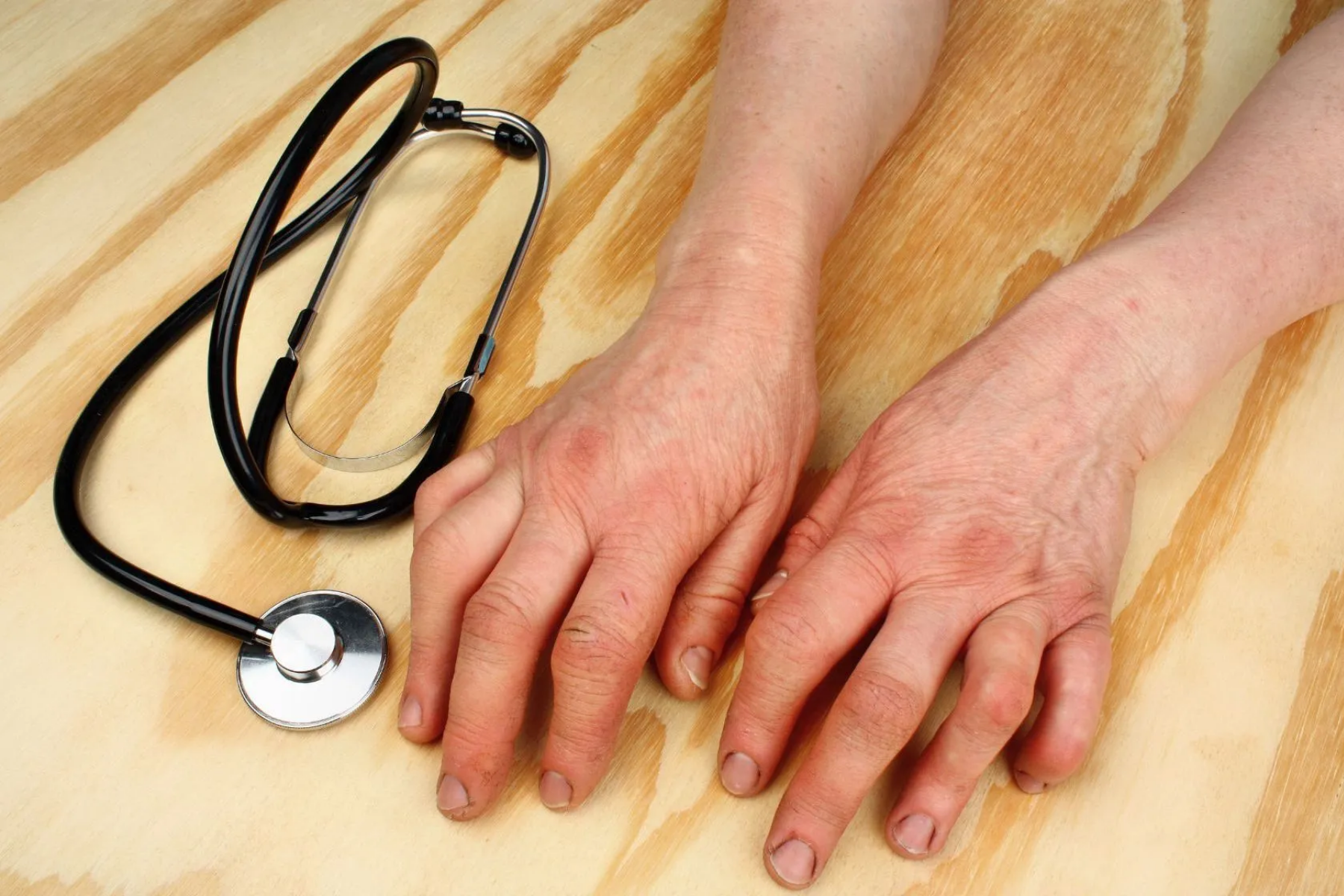 Hands with swollen fingers rest on wooden surface next to a stethoscope, representing psoriatic arthritis symptoms and diagnosis process