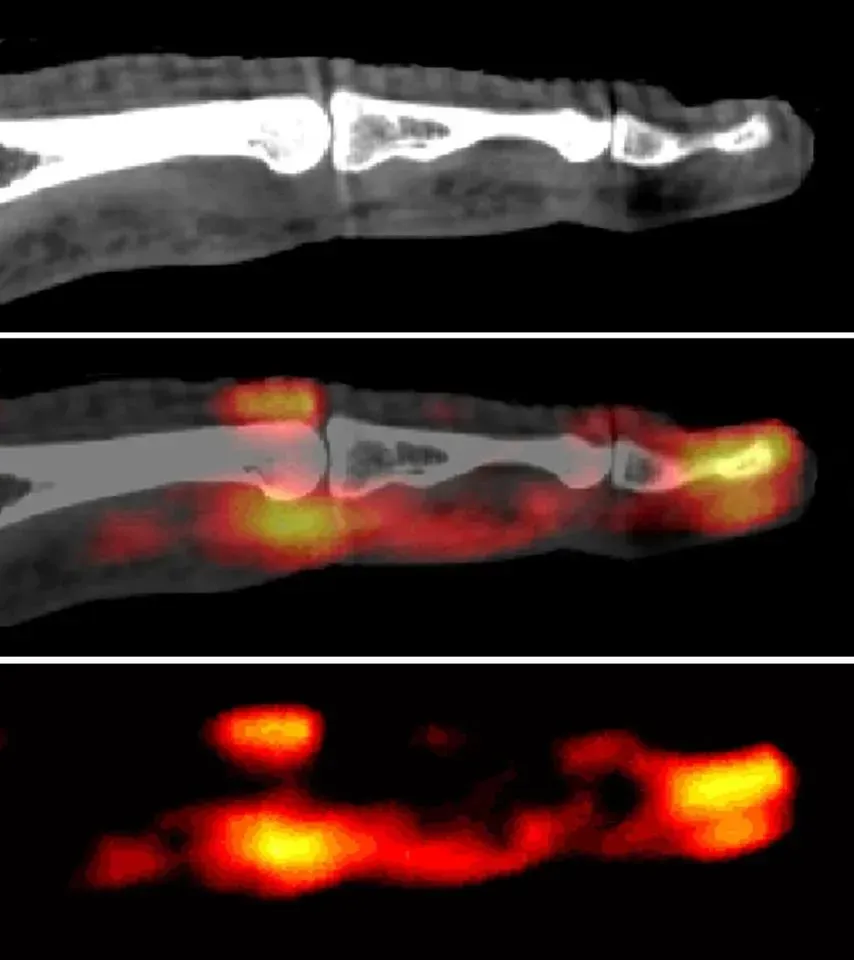 Medical imaging sequence showing Rheumatoid Arthritis early diagnosis process: bone scan of a finger in grayscale, with inflammation hotspots highlighted in red and yellow, demonstrating active chronic inflammatory disorder