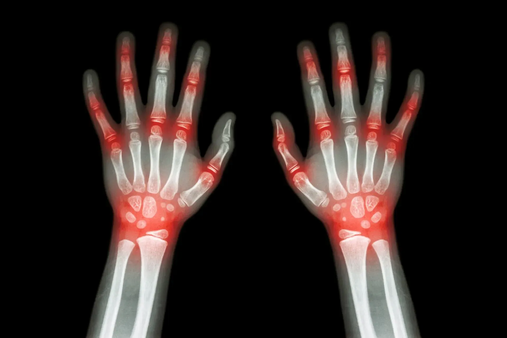 X-ray of both hands showing rheumatoid arthritis symptoms with red highlighting indicating joint pain and swelling in wrists and multiple finger joints, demonstrating characteristic RA vs osteoarthritis pattern