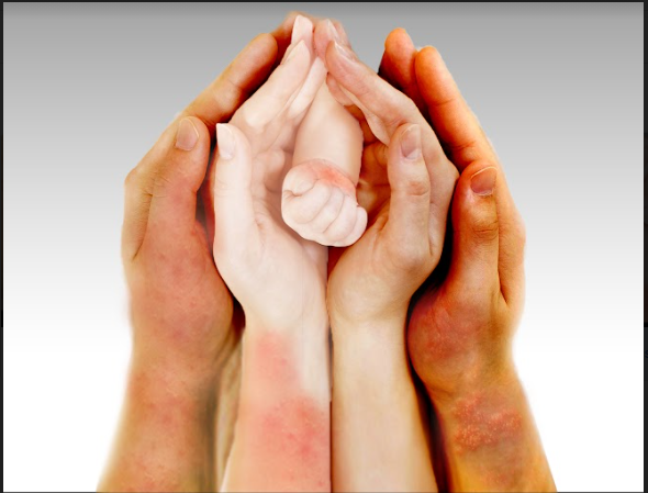 Multiple hands joined together showing varying skin tones and rashes, representing fever and rash symptoms common in the Adult-Onset Still's Disease and Systemic JIA Community