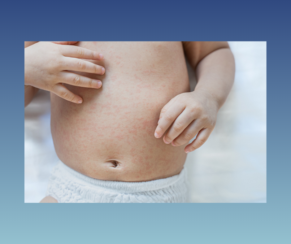 Close-up of baby's belly with red rash, small hands touching the irritated skin.