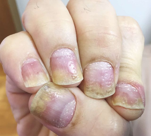 Nail Changes May Indicate Psoriatic Arthritis