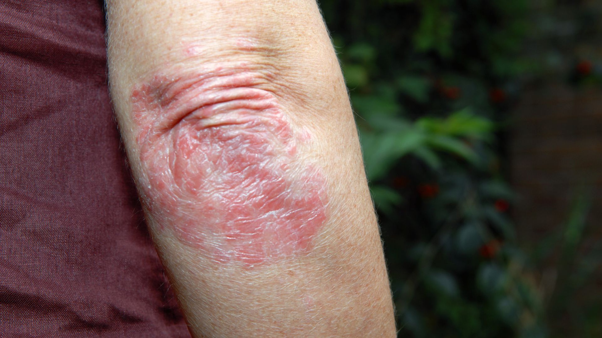 Red, scaly skin rash on a person's elbow.