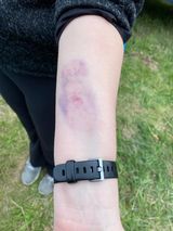 A person with a black watch on their wrist has a bruise on their arm.