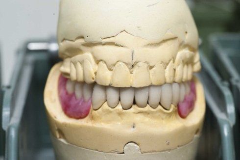 Calco con protesi dentaria