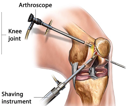 Kidney stone, urinary stone, ureteric stone, renal calculi, renal colic, nephrolithiasis