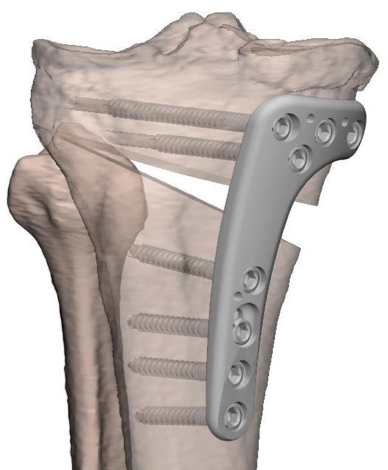 Knee Osteotomy アップデート ゼロからはじめる! Knee Osteotomyアップデート | 日本 Knee