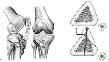 Kidney stone, urinary stone, ureteric stone, renal calculi, renal colic, nephrolithiasis