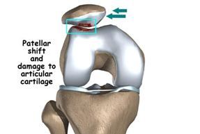 Kidney stone, urinary stone, ureteric stone, renal calculi, renal colic, nephrolithiasis