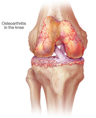 Kidney stone, urinary stone, ureteric stone, renal calculi, renal colic, nephrolithiasis