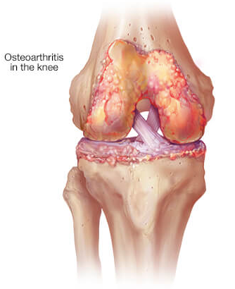 Osteoarthritis - Connecticut Orthopaedics