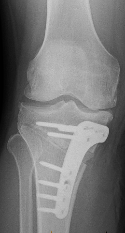 Kidney stone, urinary stone, ureteric stone, renal calculi, renal colic, nephrolithiasis