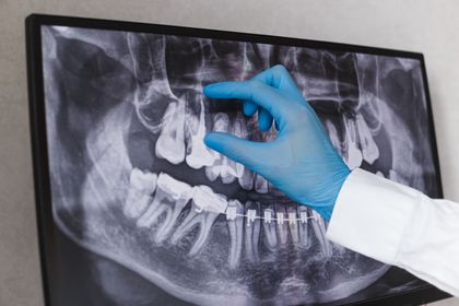 Una persona in camice bianco e guanto medico blu indica una radiografia panoramica dentale visualizzata sullo schermo di un computer.