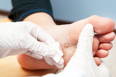 Warts Care — Treating of Warts in Jackson, MI