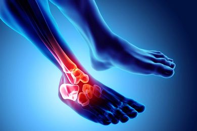 Arthritic Foot  — Skeleton X-Ray in Jackson, MI