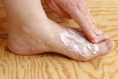 Athletes Foot — Woman Puts Some Cream On Her Foot in Jackson, MI