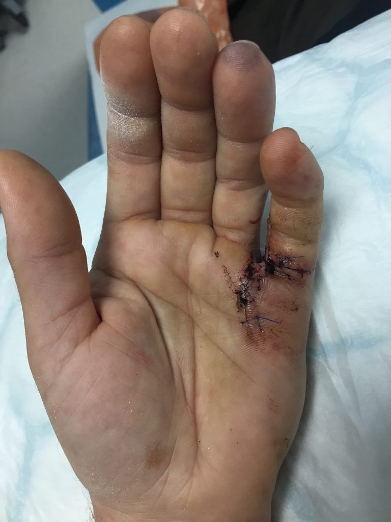 Three things I learned from hand surgery