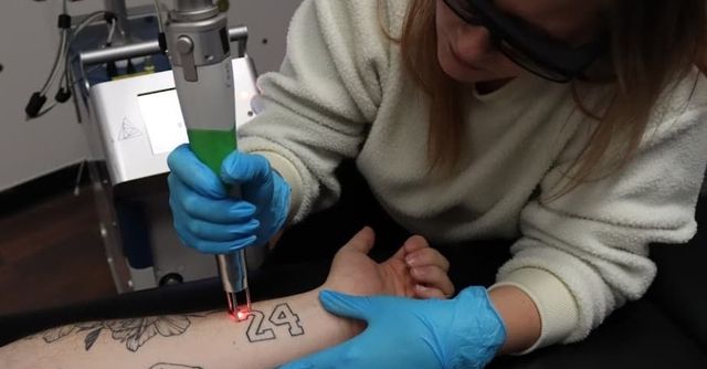 Laser Tattoo Removal in Fort Wayne IN  NoSweat Fort Wayne