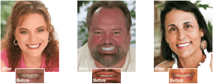 Before and After - Tallahassee Cosmetic Dentist in Tallahassee FL